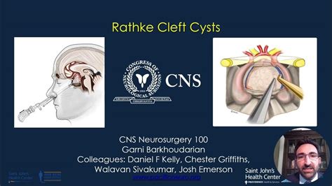 rathke's cleft cyst monitoring.